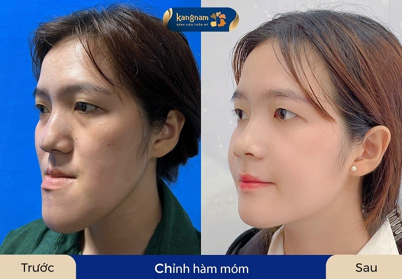 Với những trường hợp móm nặng thời gian hồi phục sẽ kéo dài hơn