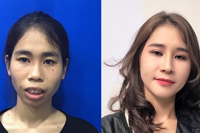 Sau khi ổn định gương mặt của khách hàng cân đối hơn