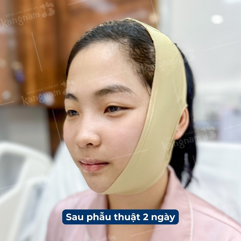Khi mới phẫu thuật gương mặt sẽ bị sưng tấy