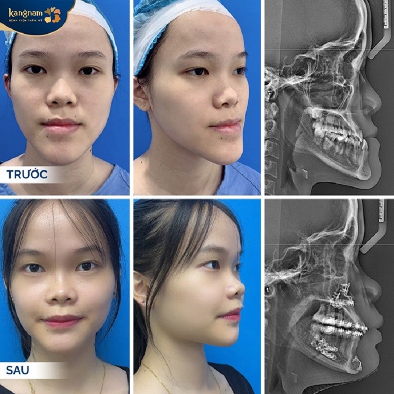 Phẫu thuật trượt cằm đảm bảo an toàn khi thực hiện tại cơ sở uy tín
