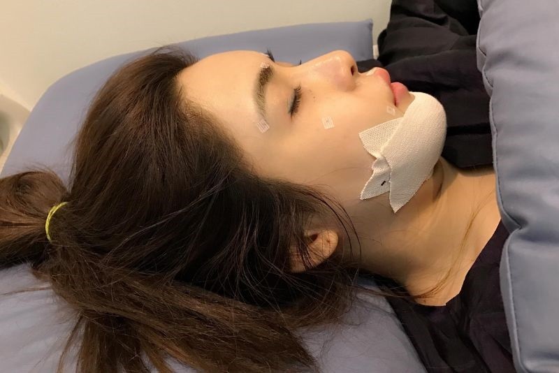 Tổn thương dây thần kinh nếu trượt cằm không đúng kỹ thuật