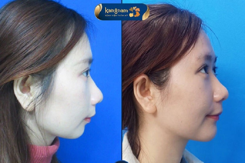 Chăm sóc đúng cách giúp vùng cằm nhanh phục hồi