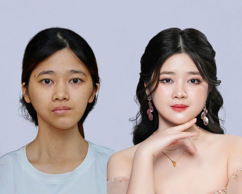 Ca chỉnh hàm phức tạp trong Hành trình Lột xác