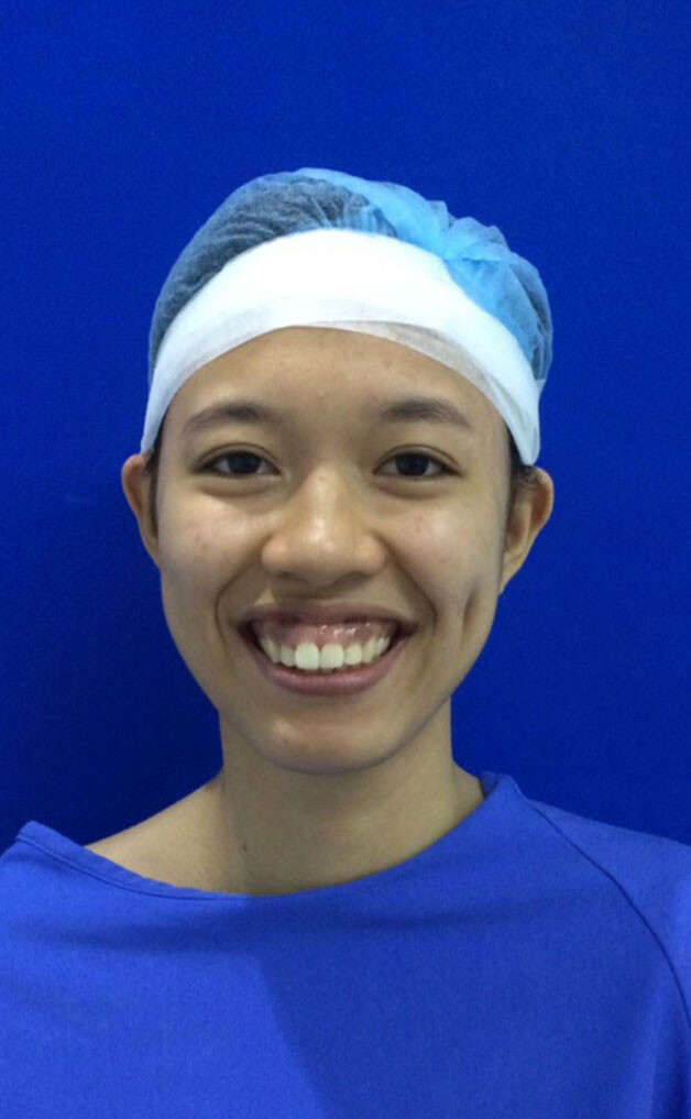 Cười hở lợi do hàm hô