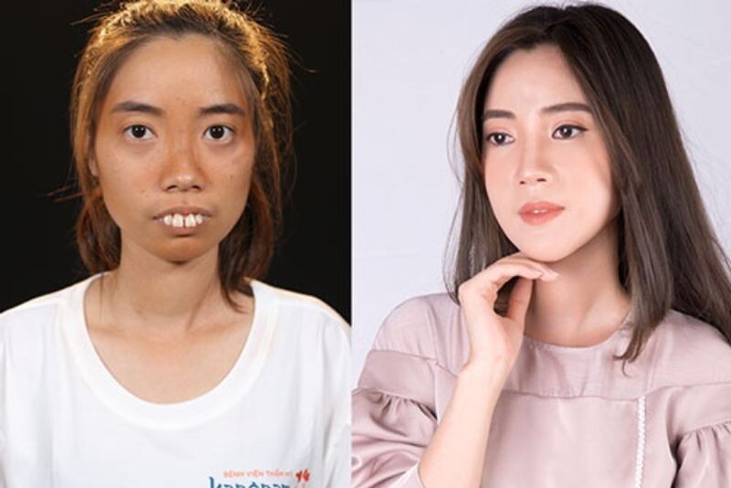 Nguyễn Thị Huê trước và sau cuộc phẫu thuật