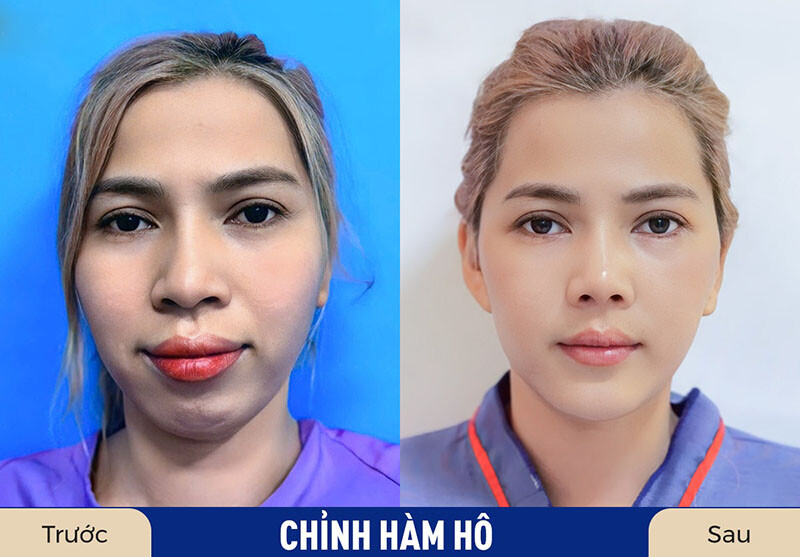 Chỉnh hàm hô không cần nhổ răng