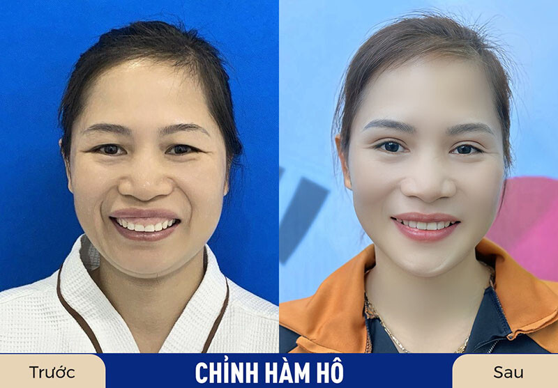 Hàm hô, cười hở lợi được chỉnh sửa toàn diện