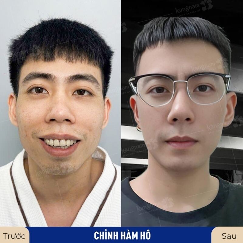 Hô do xương hàm quá phát chỉ cần điều chỉnh hàm