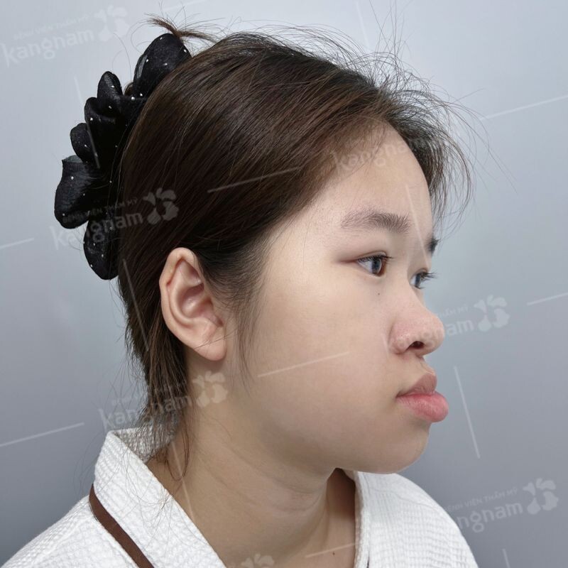 Trường hợp móm do xương hàm cần phẫu thuật