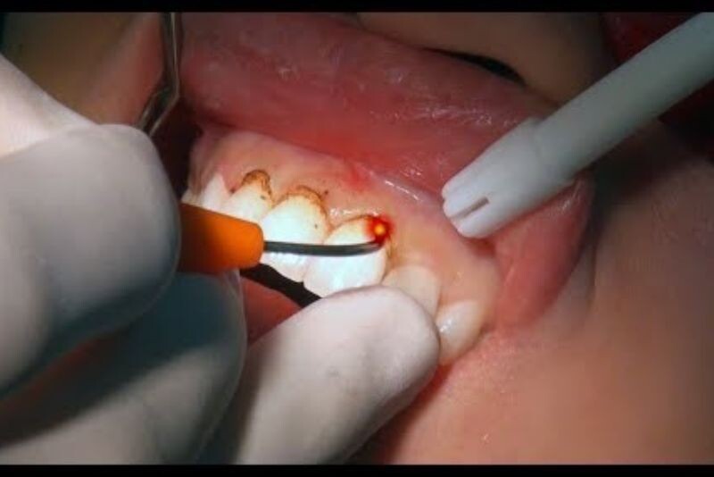 Toàn bộ quy trình chỉ kéo dài 15–30