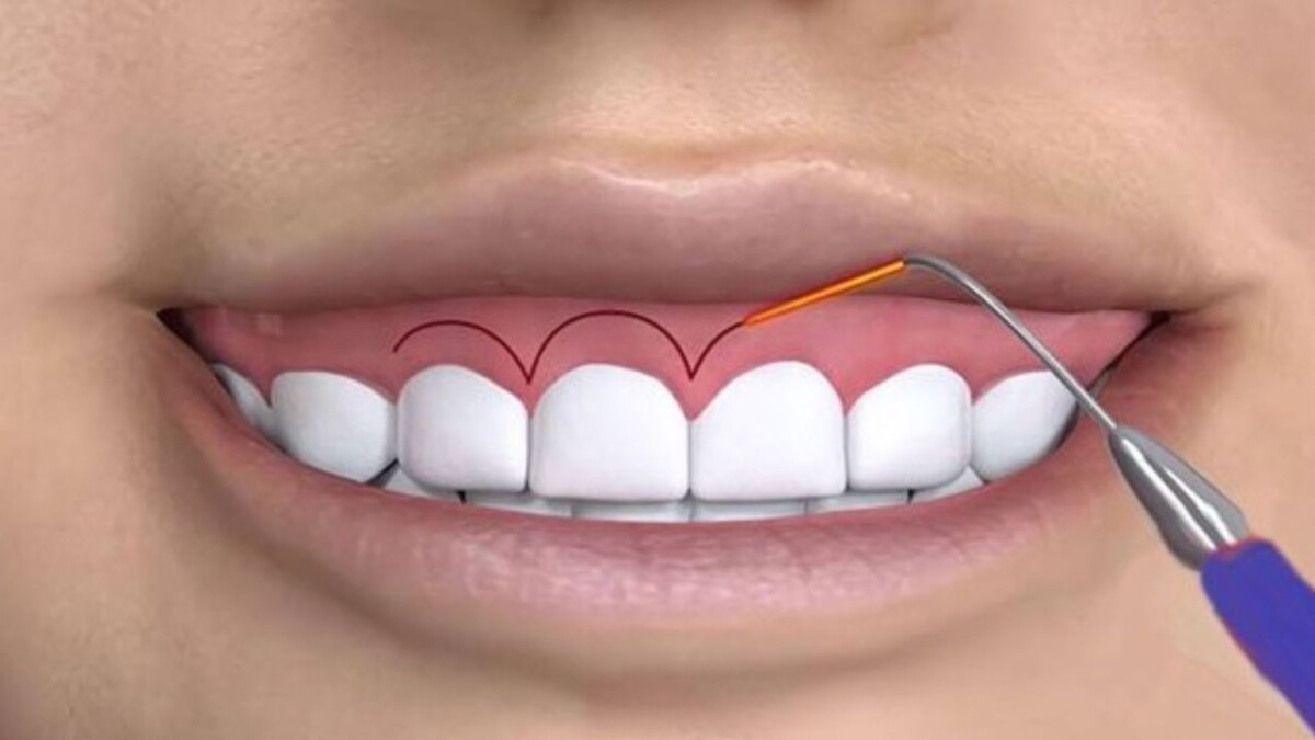 chữa cười hở lợi bằng laser