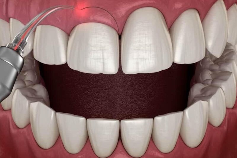 Tia laser có bước sóng phù hợp