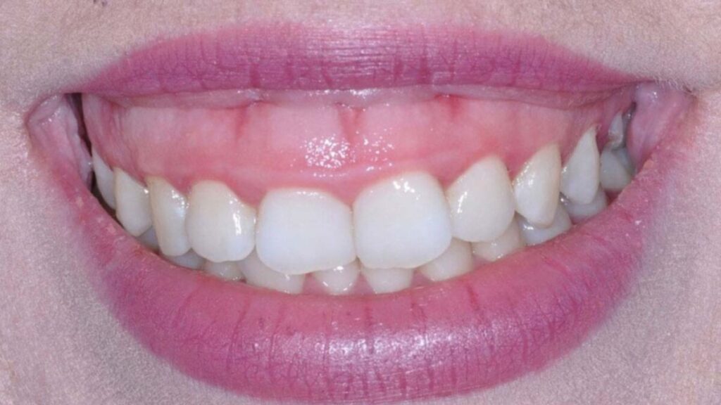 Cười hở lợi có chữa được không? 4 phương pháp chữa cười hở lợi phổ biến