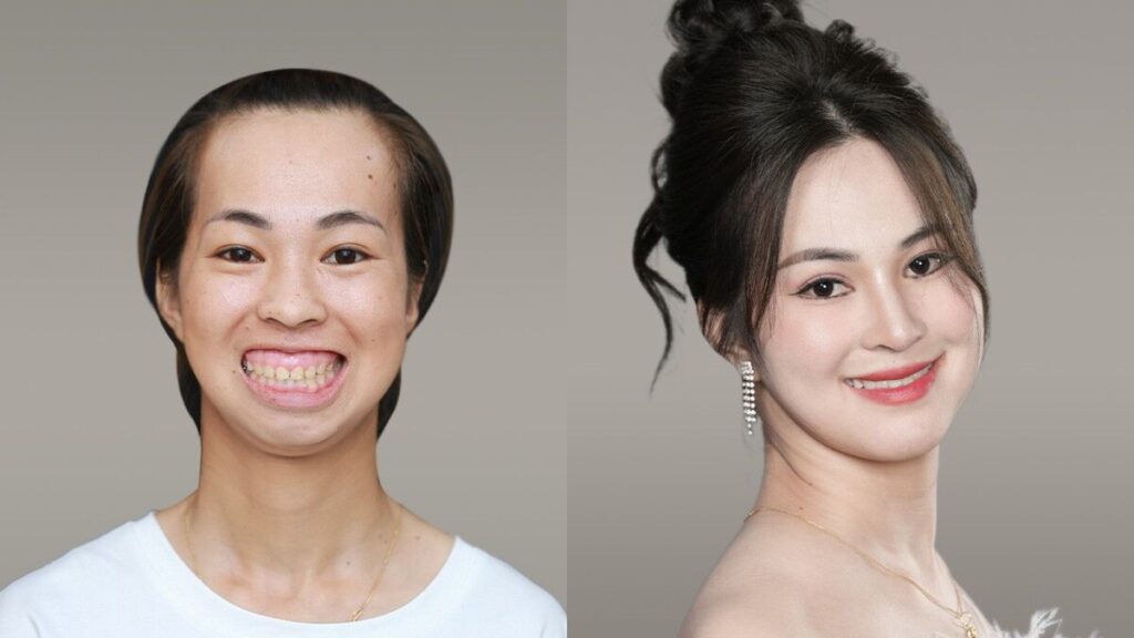 Cười hở lợi có di truyền không? 5 nguyên nhân gây cười hở lợi