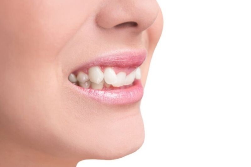 Cười hở lợi do khớp cắn sâu