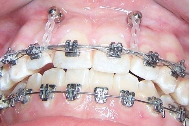 Đánh lún răng cửa bằng minivis