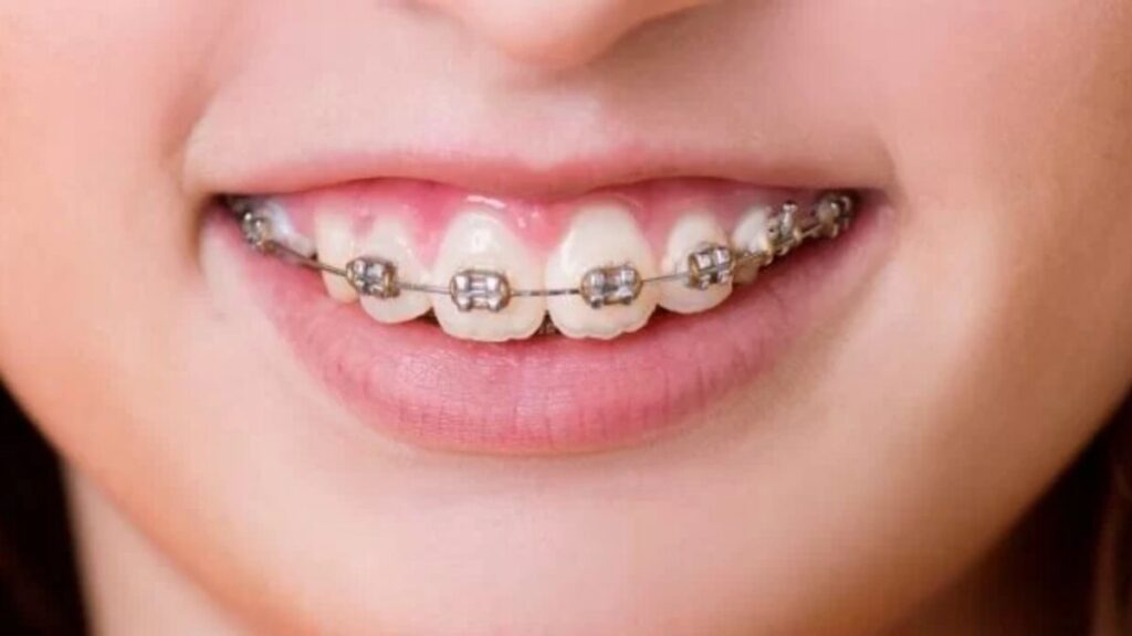 Cười hở lợi sau niềng răng: 5 nguyên nhân và cách khắc phục hiệu quả