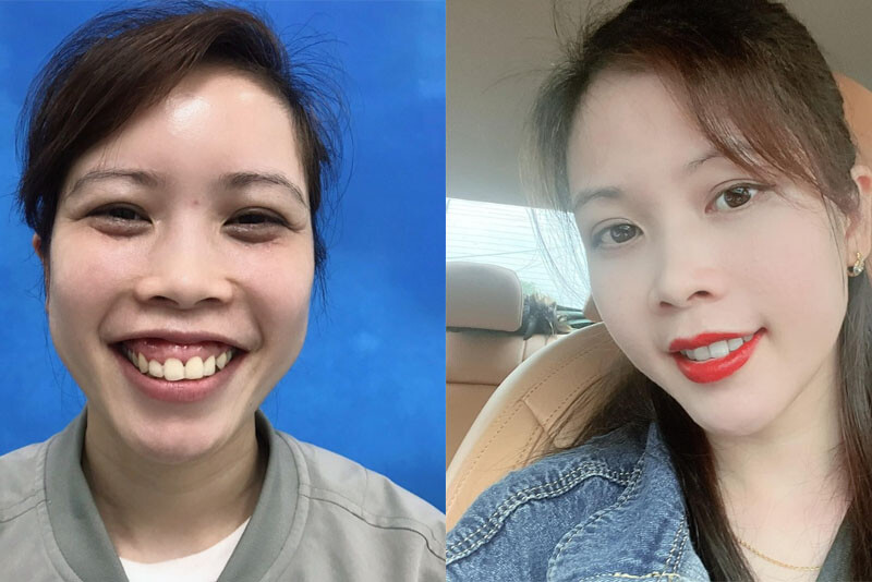 Chình hàm hô xóa sổ cười hở lợi