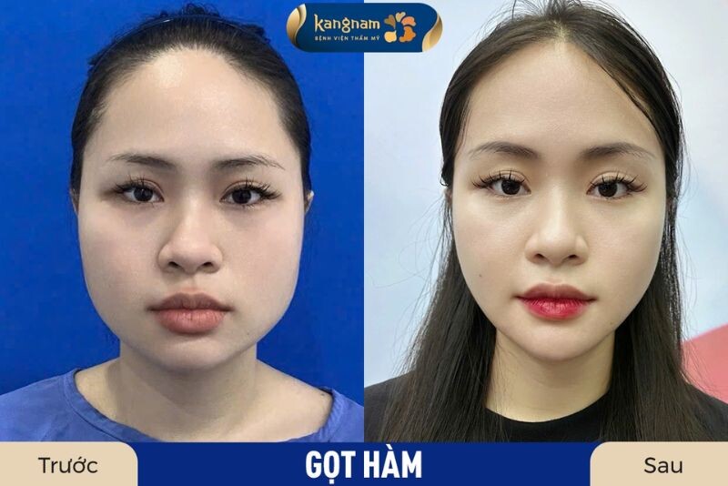Xương hàm bạnh nên gọt hàm