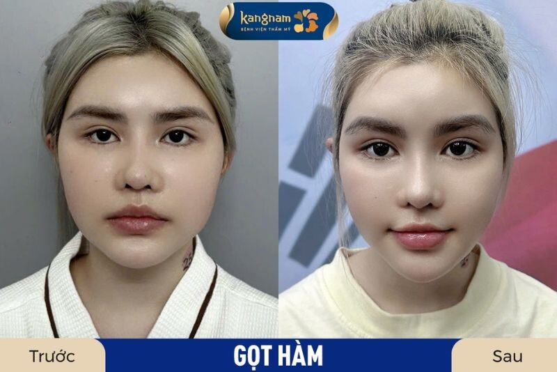 Nhiều khashc hàng tin tưởng gọt hàm tại Kangnam