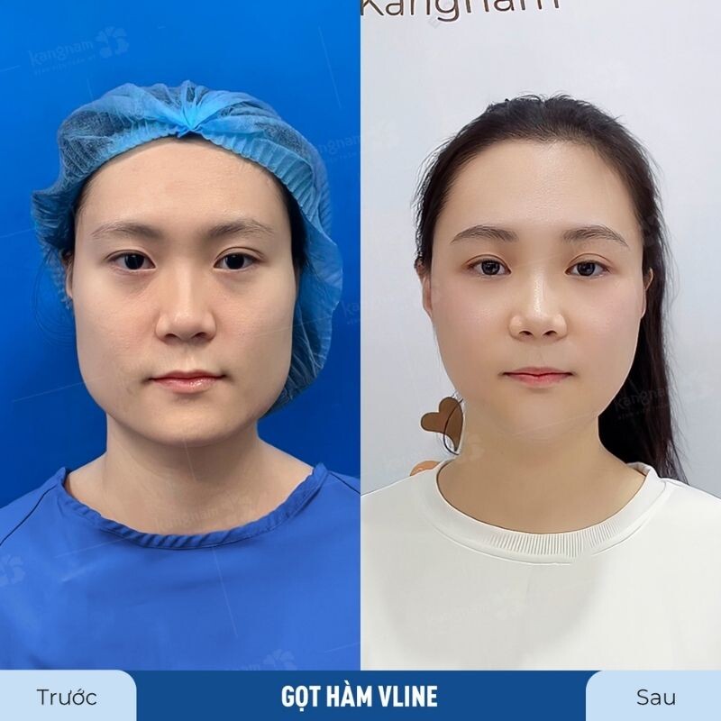 Kết quả gọt hàm từ khách hàng thực tế