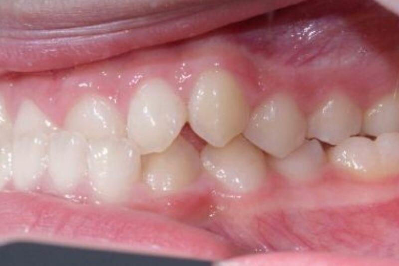 Móm do răng mọc sai vị trí