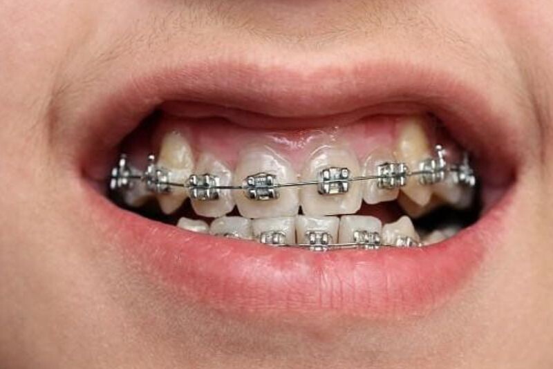 Trường hợp có thể cần nhổ răng