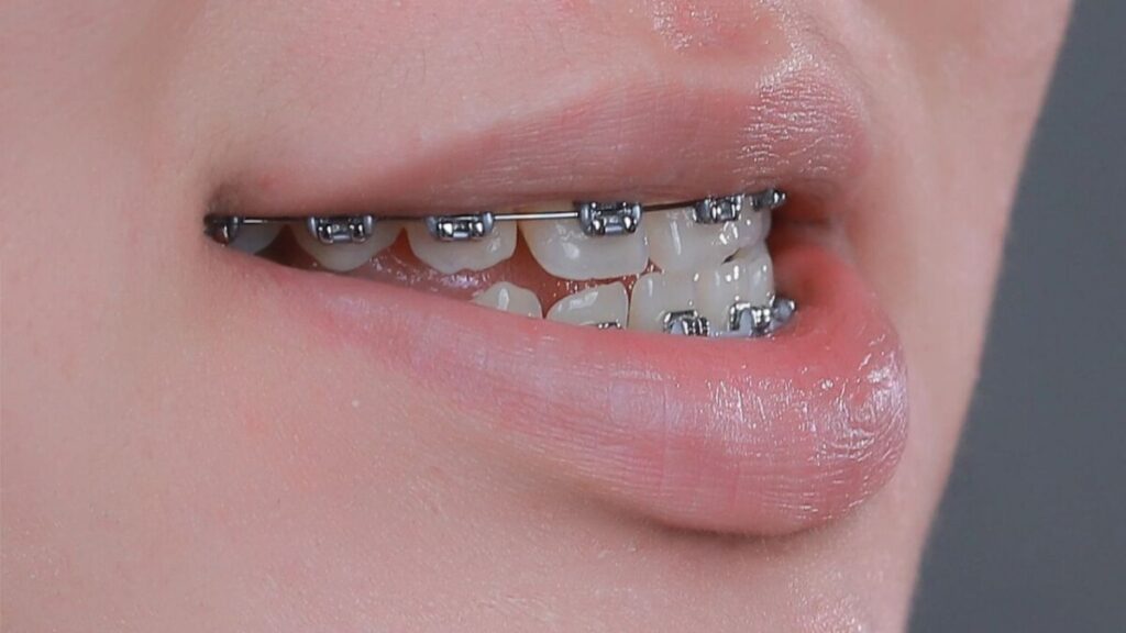 Hàm móm có niềng răng được không? 3 Trường hợp có thể niềng