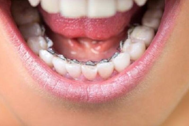 Móm do răng chìa có thể niềng răng