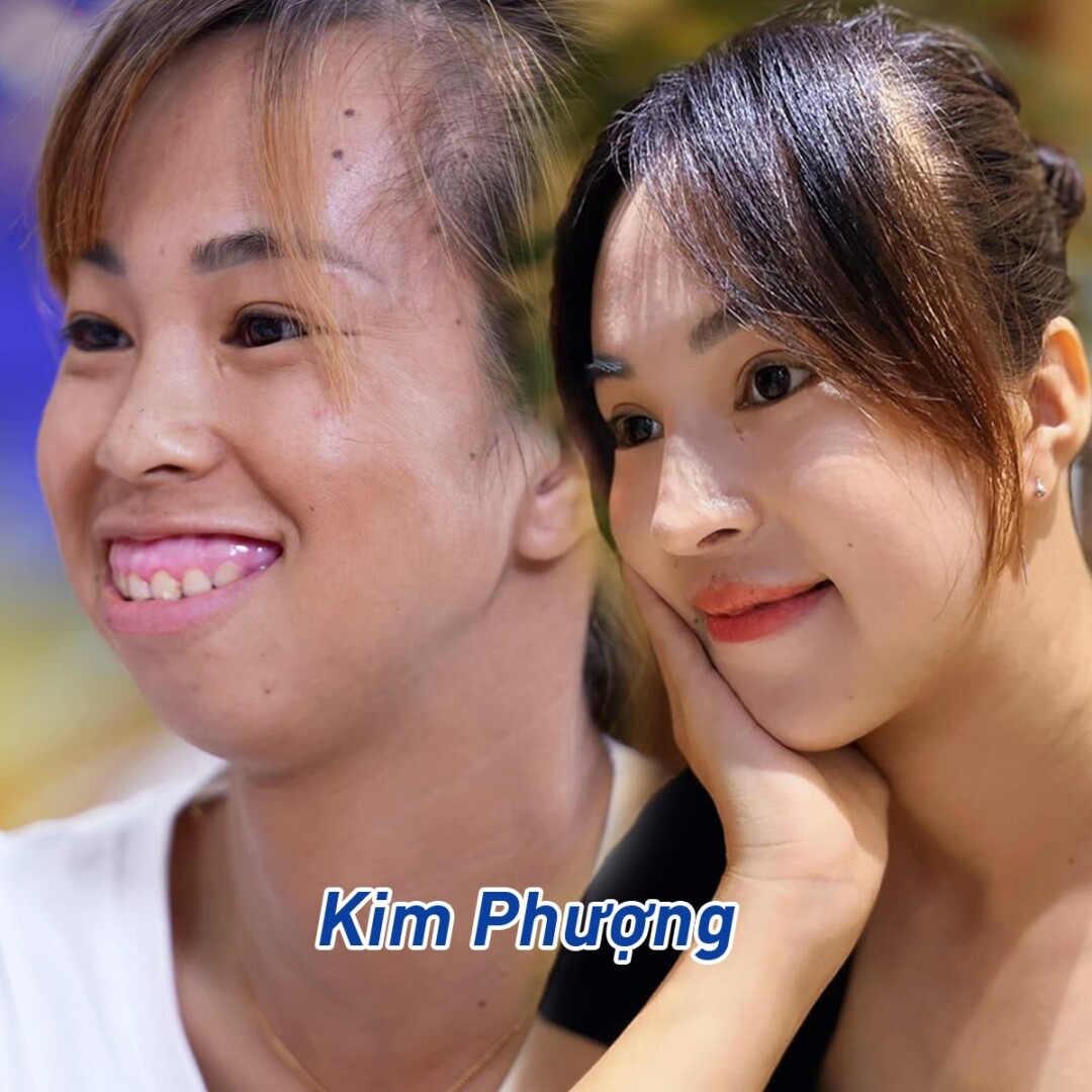 Thí sinh Kim Phượng chỉnh hàm trong Hành trình Lột xác