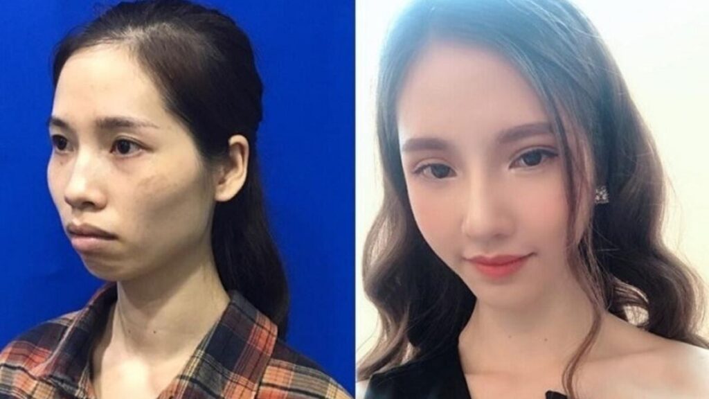 Phẫu thuật hàm hô không nhổ răng là như nào? Đối tượng phù hợp