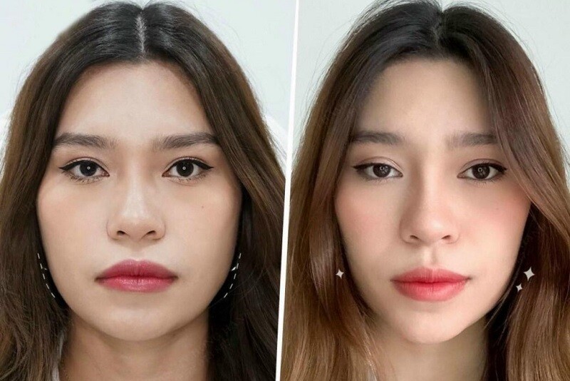 Khách hàng trước và sau khi tiêm botox gọn hàm