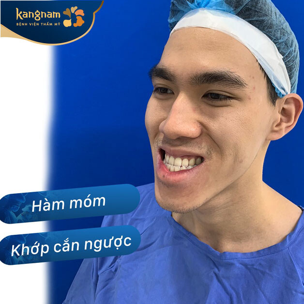Minh họa hàm móm, khớp cắn ngược
