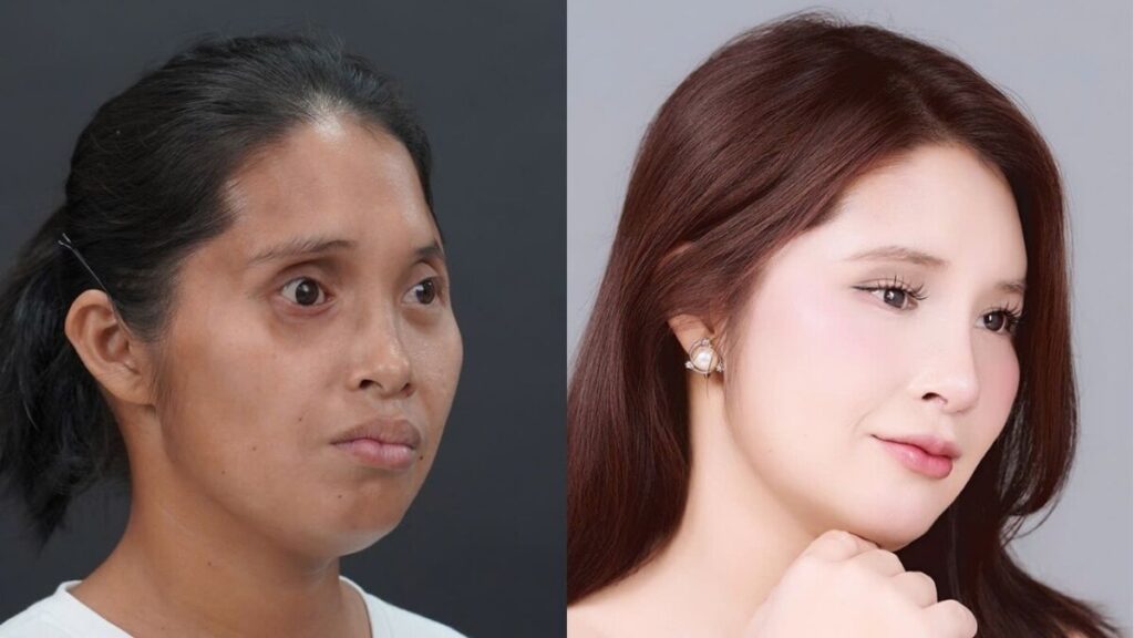 Bác Sĩ Nào Thực Hiện 7 ca Phẫu Thuật Cho Lê Thị Yến Trong Tập 3 Hành Trình Lột Xác?