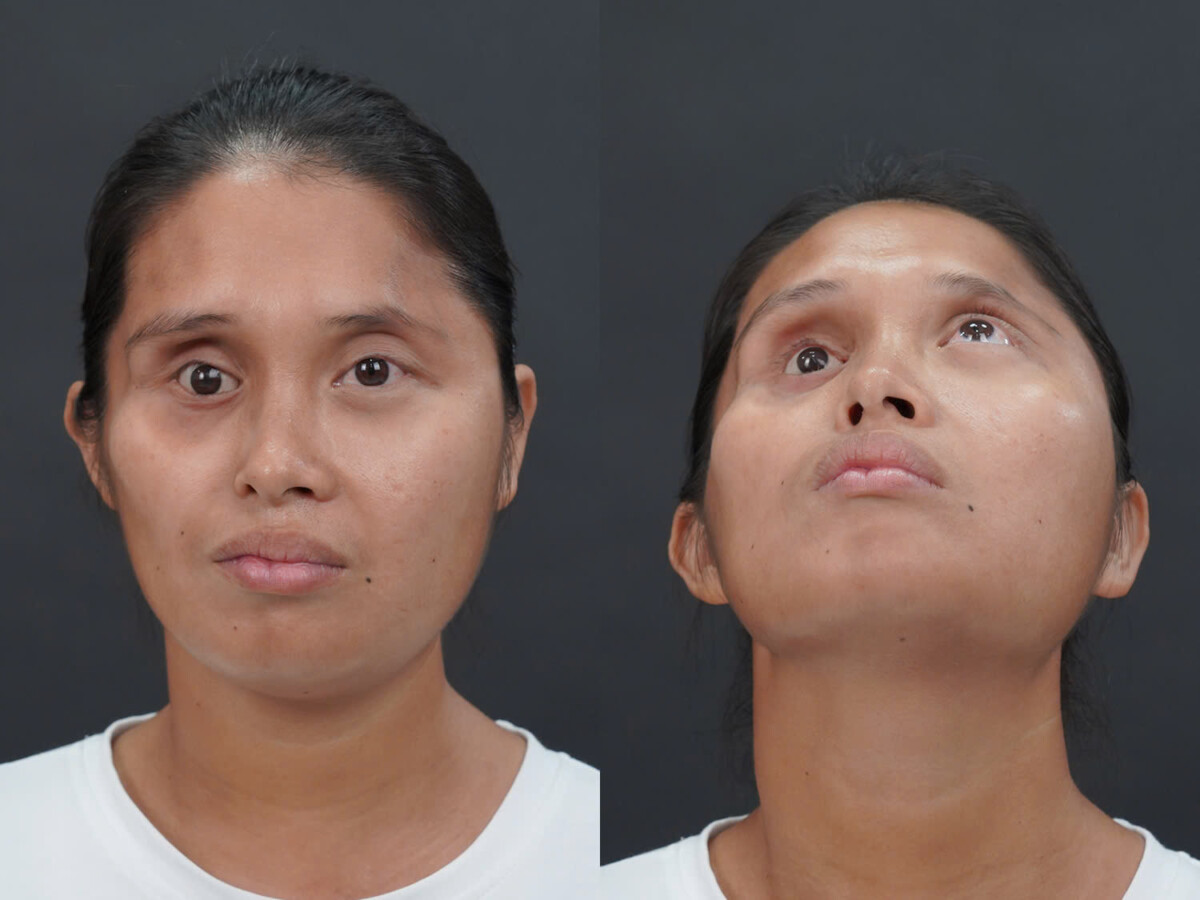 tình trạng của Lê Thị Yến dị tật phức tạp do đột biến nhiễm sắc thể dạng “ziczac”, khiến cơ thể và khuôn mặt phát triển mất cân đối từ nhỏ