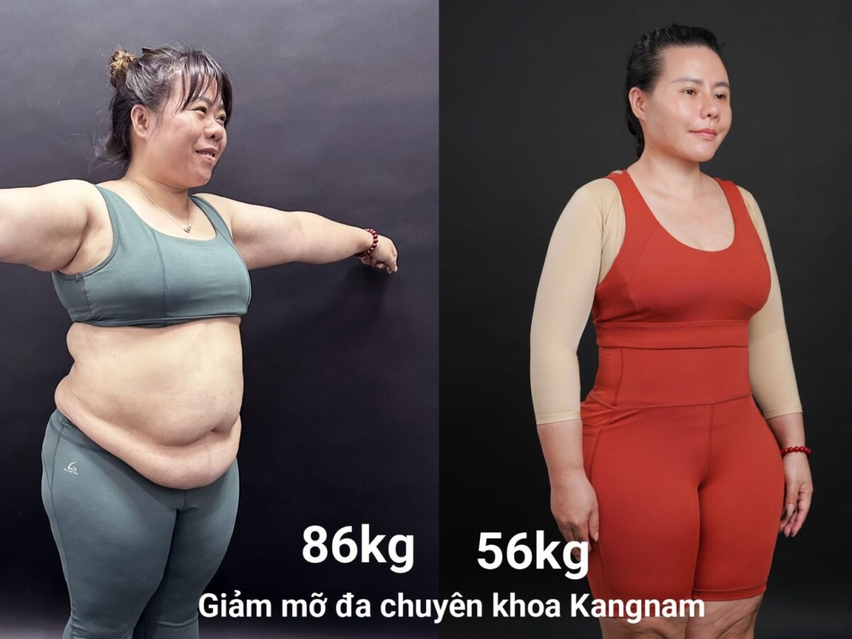 Kết quả vượt mong đợi sau 3 tháng với lộ trình giảm mỡ khoa học tại Kangnam